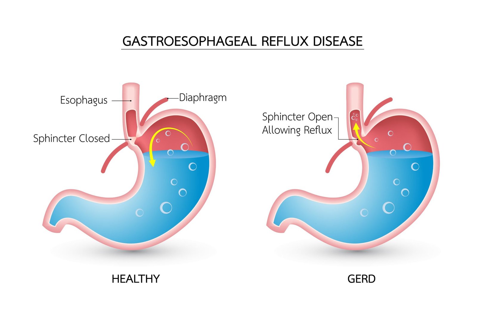 Gastroesophageal Reflux Disease | Association of South Bay Surgeons
