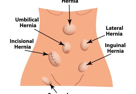 June is National Hernia Awareness Month