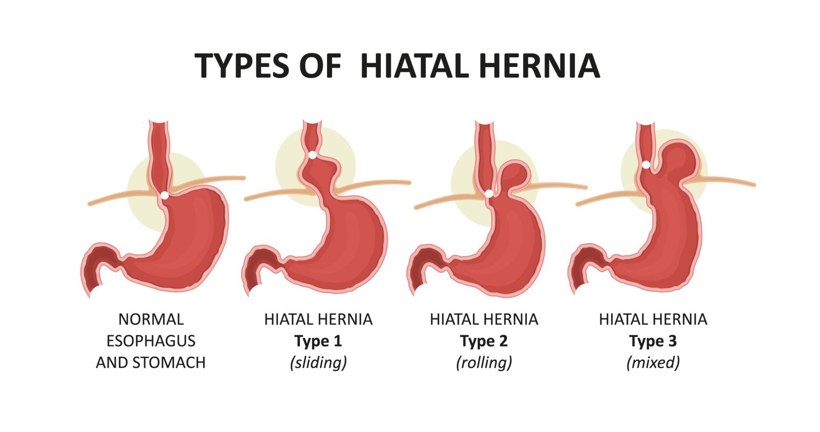 Types Of Hernias Diagram